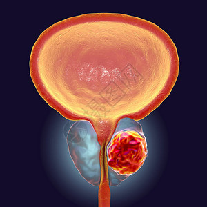 前列腺癌3D图解显示前列腺内有肿瘤图片
