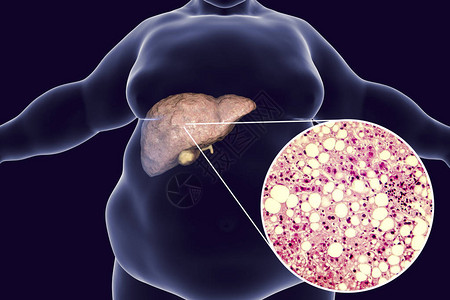 患有脂肪肝脏3D图解和肝胃病照片显微镜的肥胖男子非酒精脂肪肝病图片
