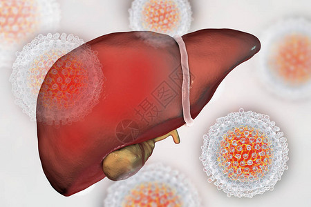 敖丙丙肝炎感染的肝脏炎CHC设计图片