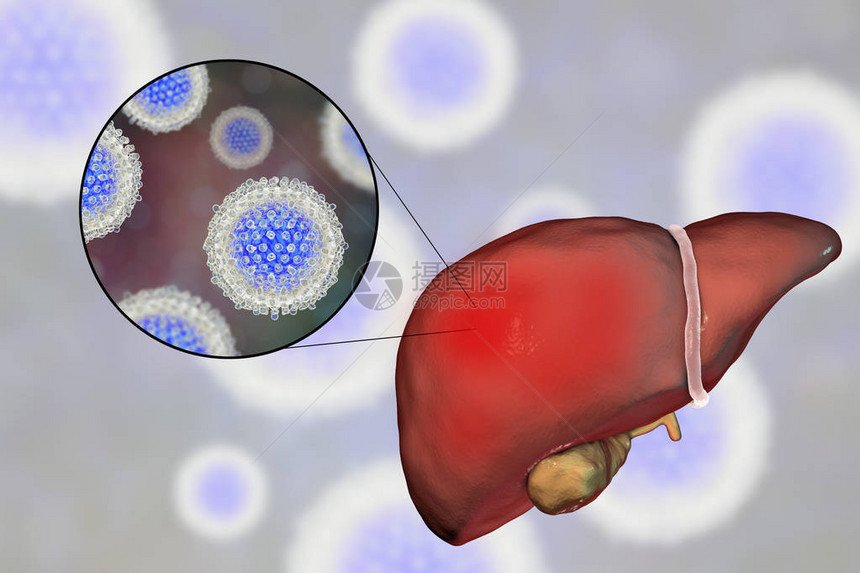 丙型肝炎感染的肝脏和丙型肝炎HCV的特写视图图片