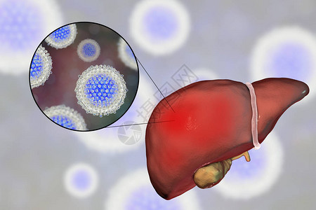 性传播丙型肝炎感染的肝脏和丙型肝炎HCV的特写视图插画