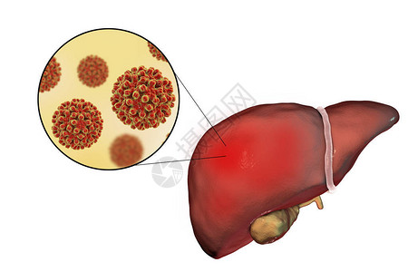 肝炎B感染的肝热和对乙型肝炎的近图片