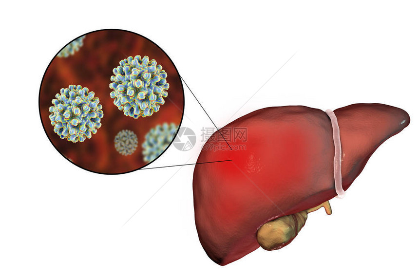 肝炎B感染的肝热和对乙型肝炎的近图片