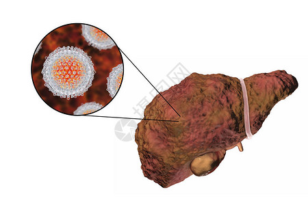 黄病毒肝硬化阶段丙型肝炎感染的肝脏和丙型肝炎HCV3D插设计图片