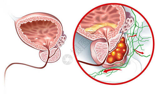 淋巴管医学说明显示前列腺和前列腺癌健康以插画