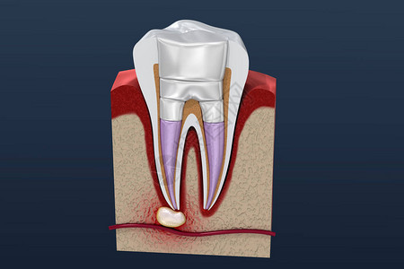 牙科补牙程序图示m图片
