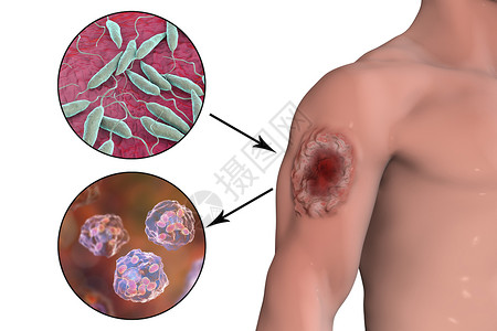 上下3D插图中莱什马尼亚血型蛋白细胞的溃疡和近视高端和大米特戈斯感染了人类骨细胞底设计图片