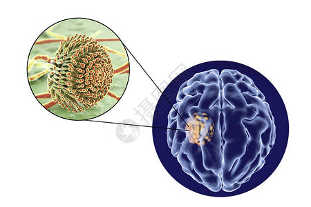 右前庭球囊肿脑曲霉菌和真菌曲霉菌的特写视图插画