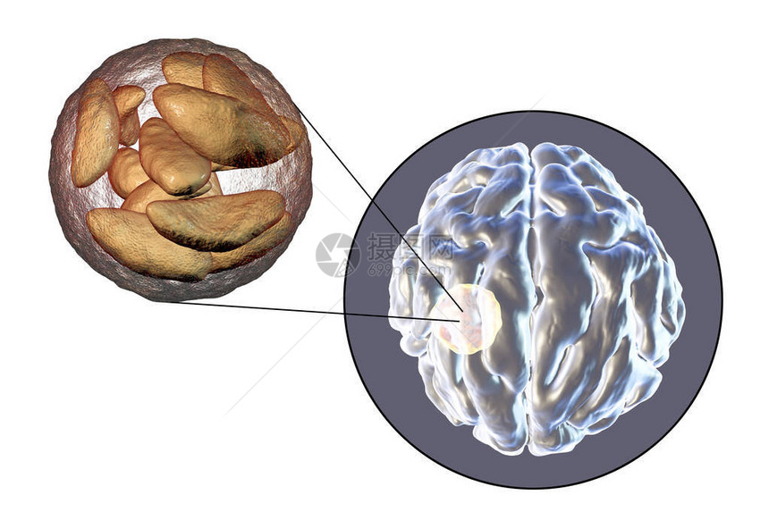 寄生虫原生动物刚地弓形虫引起的脑脓肿和脓肿腔内弓形虫寄生虫的特写视图图片