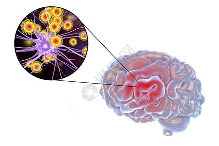 3D插图显示大脑和突变神经元高清图片