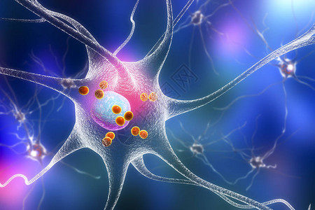 帕金森病3D插图显示含有路易体小红球的神经元设计图片