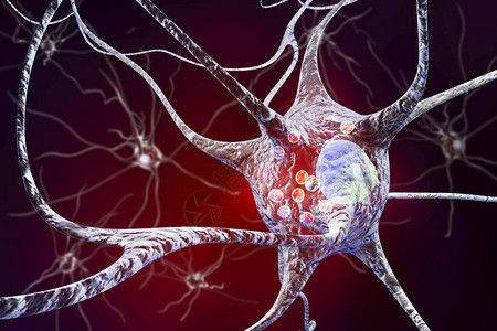 帕金森病3D插图显示含有路易体小红球的神经元背景图片