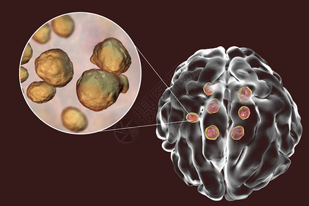 酵母脑部密码和真菌病原体近视的多种加密细胞囊肿设计图片