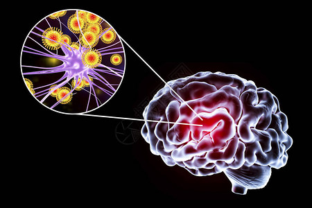 披膜病毒科3D插图显示大脑和突变神经元设计图片