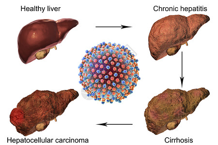 肝炎C感染的肝病例增背景图片