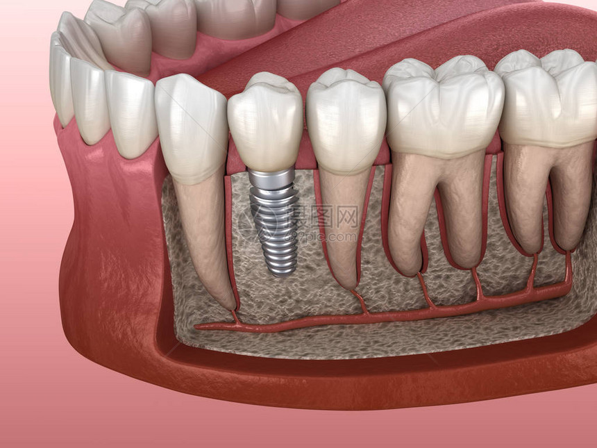 种植体修复前磨牙人类牙齿和假牙概念的医学上准确的图片