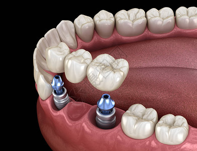 用植入器支持的牙科桥医学上准确的3D人类牙齿和背景图片