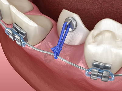 易受影响精确医学的牙科3D插图用于矫正的有影响设计图片