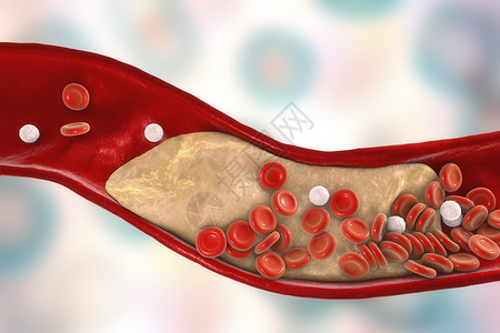 动脉中的胆固醇斑块3D插图冠状背景图片