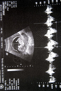 我的新出生婴儿的超声波图片