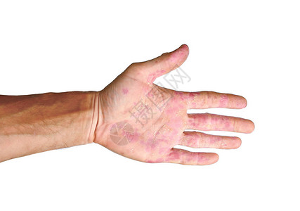 手掌病人红斑在溃疡中从白色背景分离的炎背景图片