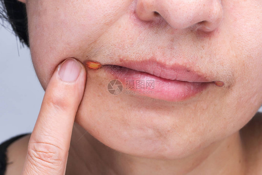 角天颈炎是嘴唇经常发图片