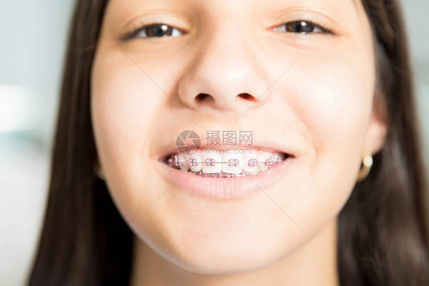 在牙科诊所戴牙套的笑图片