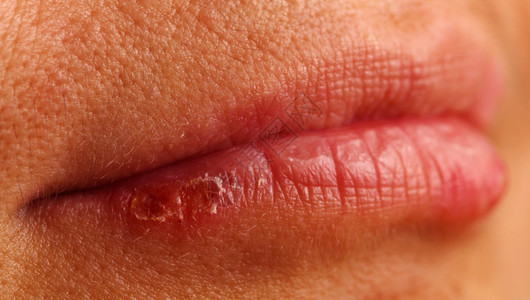 鼻唇沟女下唇疱疹的表现背景