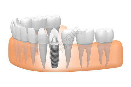 钛蟒种植牙种植牙设计图片