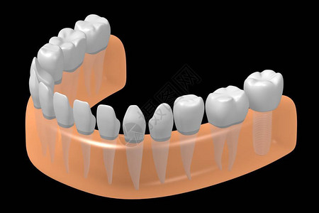 3D牙科图片