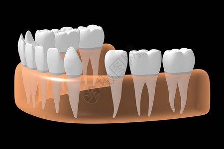 缺硒3D缺失牙设计图片