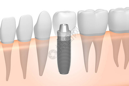 钛蟒种植牙种植牙设计图片