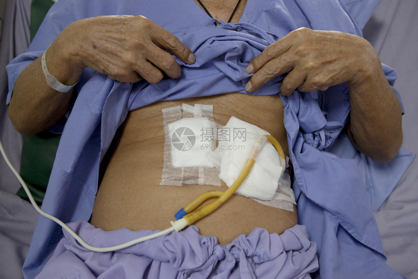 在医院床上躺着的病人胃部图片