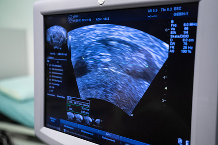 孕期超声波扫描未图片
