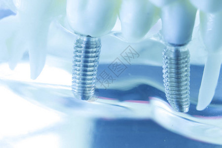 牙科钛美学正畸牙种植体在牙医口腔牙齿模背景图片