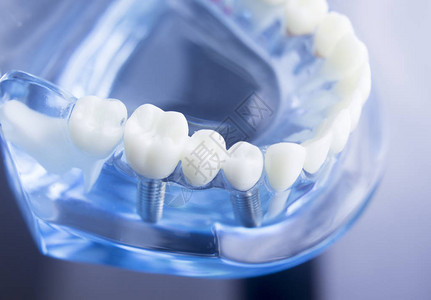 牙齿科学生习教学模型显示牙齿牙根牙龈牙龈疾病图片