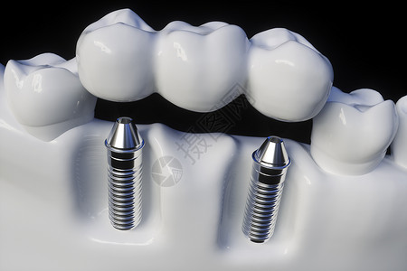 拉直牙齿人类植入物设计图片