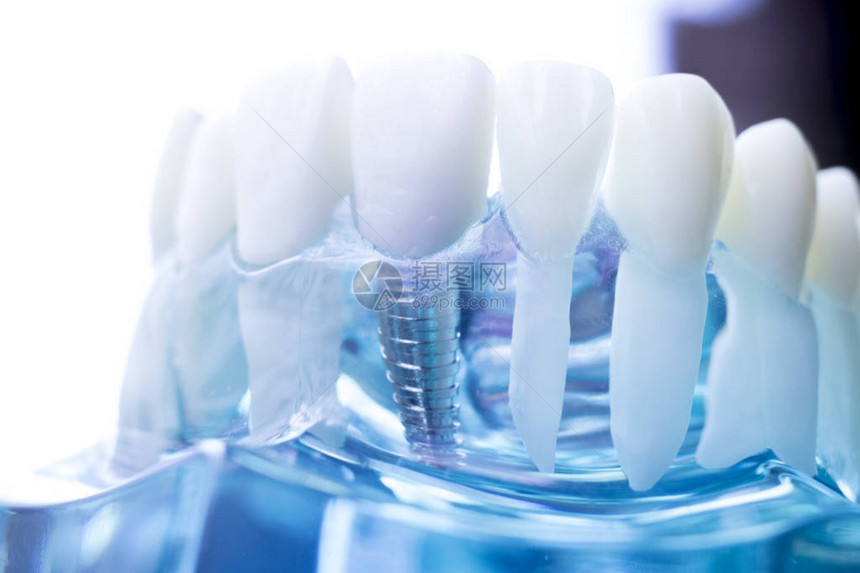 牙科医齿教学模型显示钛金属牙植图片