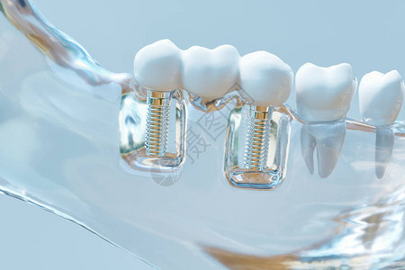 牙齿人类植入物图片