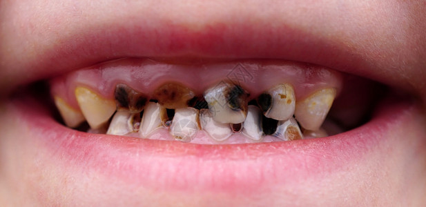 孩子牙齿上的龋齿图片