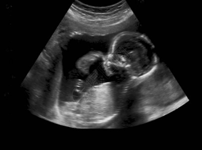 妈子宫里的婴儿的超声波图片