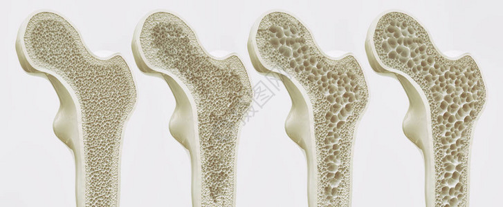 海绵状的骨质疏松4级设计图片