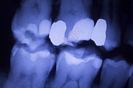 牙科医齿X光显图片