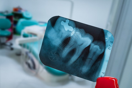 在X光胶片放映和Tweezer与牙科诊所对抗时使用模糊的背景t图片