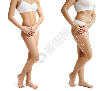 两个年轻的粗壮和瘦弱的女人有着不同的身材比较概念又瘦胖的女孩减脂吸脂和去除脂肪团的概念整形手术前的女人身上的图片