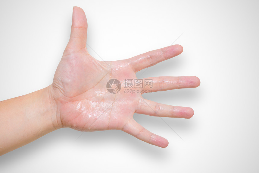 汗液综合症导致的多汗湿手图片