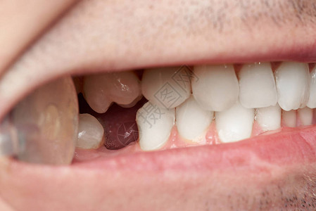 牙齿缺失的牙齿特写医生检查牙齿图片