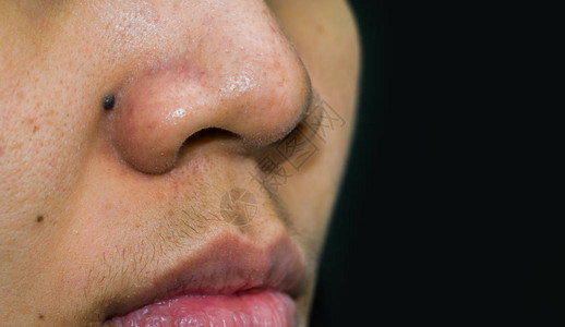 鼻子后面的黑痣需要CO2激光去除亚洲女人鼻子上的黑头粉刺粉刺和毛孔粗大的皮肤需要AHABHA或过氧化苯甲酰过量的男荷尔蒙图片