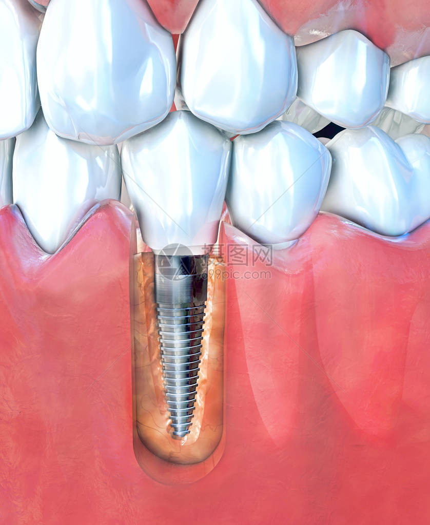 下颌牙种植体的3d插图图片