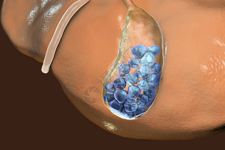 显示肝脏和胆囊与石图片